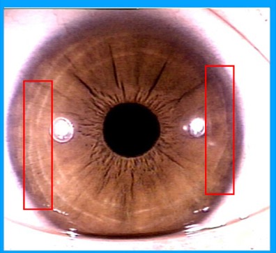 虹膜常见14种征象分析